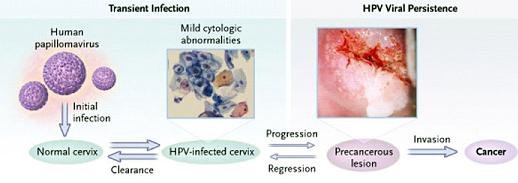 Development of cervical cancer